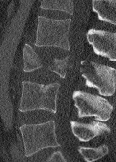 IM-0005-0083 L-spine.jpg IM-0005-0083 L-spine.jpg