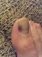 Runner's Toe (or Hiker's Toe)